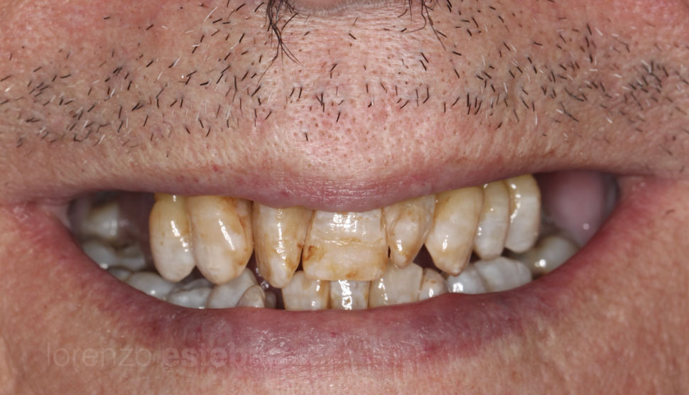 Casos Clínicos Dentales | Implantología Digital