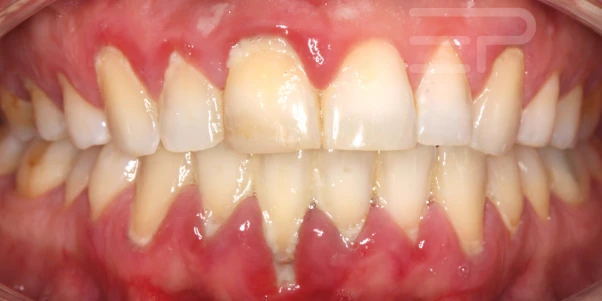 Casos Clínicos Dentales | Priodoncia Avanzada